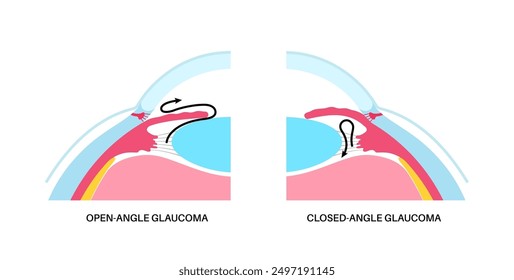 Glaucoma poster. Increased intraocular pressure, damaged optic nerve, vision loss. Blurry vision, deterioration of eyesight, halos around lights or blindness. Human eye disease vector illustration.