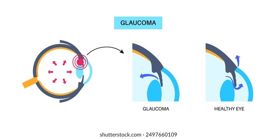 Glaucoma poster. Increased intraocular pressure, damaged optic nerve, vision loss. Blurry vision, deterioration of eyesight, halos around lights or blindness. Human eye disease vector illustration.