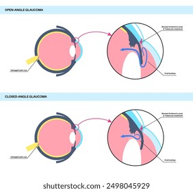 Glaucoma poster. Increased intraocular pressure, damaged optic nerve, vision loss. Blurry vision, deterioration of eyesight, halos around lights or blindness. Human eye disease vector illustration.