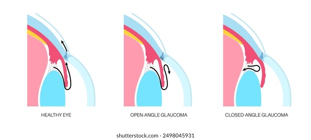 Glaucoma poster. Increased intraocular pressure, damaged optic nerve, vision loss. Blurry vision, deterioration of eyesight, halos around lights or blindness. Human eye disease vector illustration.