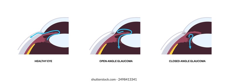 Glaucoma poster. Increased intraocular pressure, damaged optic nerve, vision loss. Blurry vision, deterioration of eyesight, halos around lights or blindness. Human eye disease vector illustration.