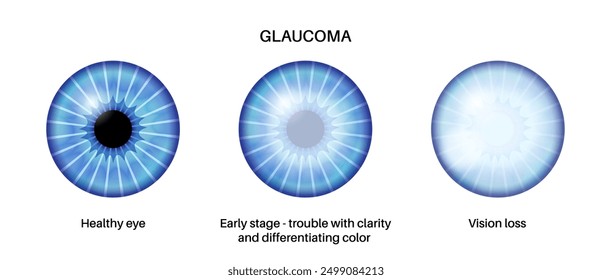 Glaucoma poster. Increased intraocular pressure, damaged optic nerve, vision loss. Blurry vision, deterioration of eyesight, halos around lights or blindness. Human eye disease vector illustration.