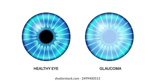 Glaucoma poster. Increased intraocular pressure, damaged optic nerve, vision loss. Blurry vision, deterioration of eyesight, halos around lights or blindness. Human eye disease vector illustration.