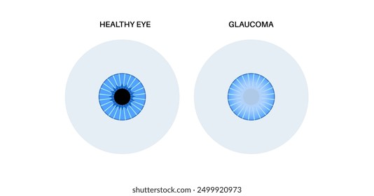 Glaukomposter. Erhöhter Augeninnendruck, beschädigter Sehnerv, Sehverlust. Verschwommenes Sehen, Verschlechterung des Sehvermögens, Heiligenschein um Lichter oder Blindheit. Vektorgrafik der menschlichen Augenerkrankung.
