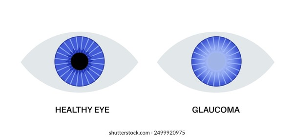 Glaukomposter. Erhöhter Augeninnendruck, beschädigter Sehnerv, Sehverlust. Verschwommenes Sehen, Verschlechterung des Sehvermögens, Heiligenschein um Lichter oder Blindheit. Vektorgrafik der menschlichen Augenerkrankung.