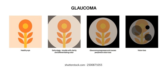 Glaukomposter. Erhöhter Augeninnendruck, beschädigter Sehnerv, Sehverlust. Verschwommenes Sehen, Verschlechterung des Sehvermögens, Heiligenschein um Lichter oder Blindheit. Vektorgrafik der menschlichen Augenerkrankung.