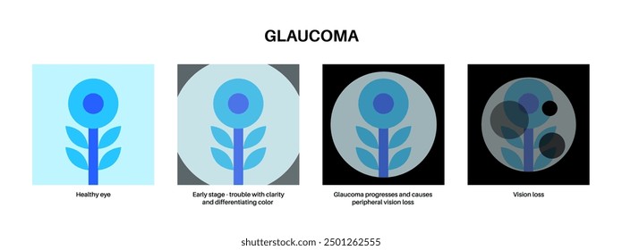 Glaukomposter. Erhöhter Augeninnendruck, beschädigter Sehnerv, Sehverlust. Verschwommenes Sehen, Verschlechterung des Sehvermögens, Heiligenschein um Lichter oder Blindheit. Vektorgrafik der menschlichen Augenerkrankung.
