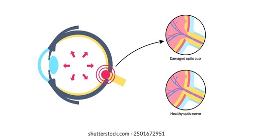 Glaucoma poster. Increased intraocular pressure, damaged optic nerve, vision loss. Blurry vision, deterioration of eyesight, halos around lights or blindness. Human eye disease vector illustration.