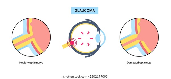 Afiche del glaucoma. Aumento de la presión intraocular, daño del nervio óptico, pérdida de la visión. Visión borrosa, deterioro de la vista, halos alrededor de las luces o ceguera. Ilustración vectorial de enfermedades del ojo humano.