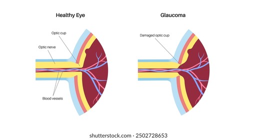 Glaukomposter. Erhöhter Augeninnendruck, beschädigter Sehnerv, Sehverlust. Verschwommenes Sehen, Verschlechterung des Sehvermögens, Heiligenschein um Lichter oder Blindheit. Vektorgrafik der menschlichen Augenerkrankung.