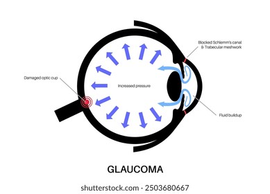 Glaukomposter. Erhöhter Augeninnendruck, beschädigter Sehnerv, Sehverlust. Verschwommenes Sehen, Verschlechterung des Sehvermögens, Heiligenschein um Lichter oder Blindheit. Vektorgrafik der menschlichen Augenerkrankung.