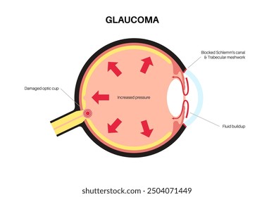 Glaucoma poster. Increased intraocular pressure, damaged optic nerve, vision loss. Blurry vision, deterioration of eyesight, halos around lights or blindness. Human eye disease vector illustration.