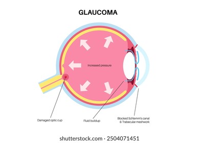 Glaucoma poster. Increased intraocular pressure, damaged optic nerve, vision loss. Blurry vision, deterioration of eyesight, halos around lights or blindness. Human eye disease vector illustration.