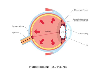 Glaukomposter. Erhöhter Augeninnendruck, beschädigter Sehnerv, Sehverlust. Verschwommenes Sehen, Verschlechterung des Sehvermögens, Heiligenschein um Lichter oder Blindheit. Vektorgrafik der menschlichen Augenerkrankung.