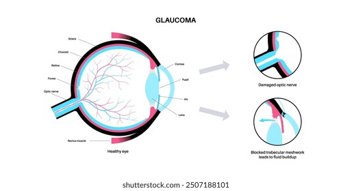 Glaucoma poster. Increased intraocular pressure, damaged optic nerve, vision loss. Blurry vision, deterioration of eyesight, halos around lights or blindness. Human eye disease vector illustration.