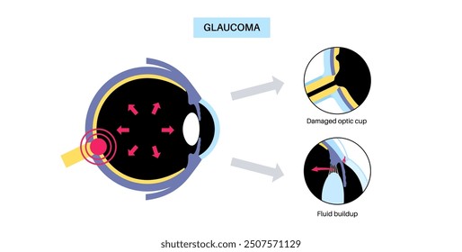 Glaukomposter. Erhöhter Augeninnendruck, beschädigter Sehnerv, Sehverlust. Verschwommenes Sehen, Verschlechterung des Sehvermögens, Heiligenschein um Lichter oder Blindheit. Vektorgrafik der menschlichen Augenerkrankung.