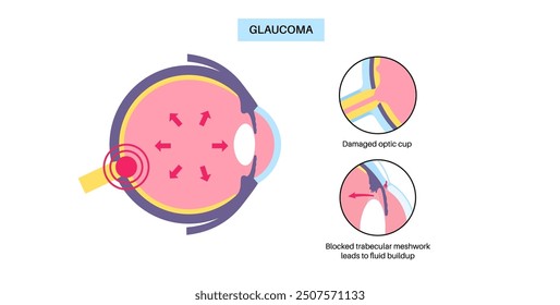 Glaukomposter. Erhöhter Augeninnendruck, beschädigter Sehnerv, Sehverlust. Verschwommenes Sehen, Verschlechterung des Sehvermögens, Heiligenschein um Lichter oder Blindheit. Vektorgrafik der menschlichen Augenerkrankung.