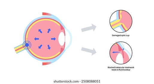 Glaukomposter. Erhöhter Augeninnendruck, beschädigter Sehnerv, Sehverlust. Verschwommenes Sehen, Verschlechterung des Sehvermögens, Heiligenschein um Lichter oder Blindheit. Vektorgrafik der menschlichen Augenerkrankung.
