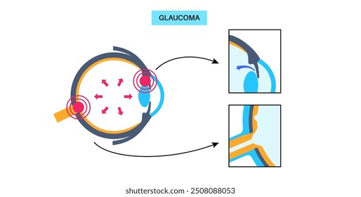 Glaukomposter. Erhöhter Augeninnendruck, beschädigter Sehnerv, Sehverlust. Verschwommenes Sehen, Verschlechterung des Sehvermögens, Heiligenschein um Lichter oder Blindheit. Vektorgrafik der menschlichen Augenerkrankung.