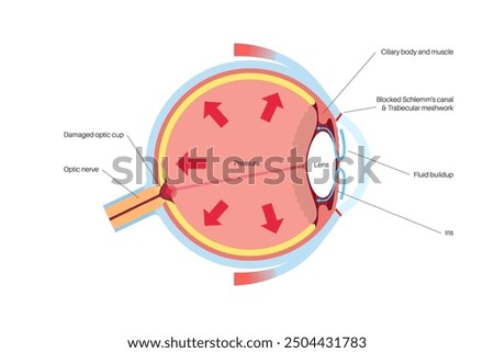 Glaucoma poster. Increased intraocular pressure, damaged optic nerve, vision loss. Blurry vision, deterioration of eyesight, halos around lights or blindness. Human eye disease vector illustration.