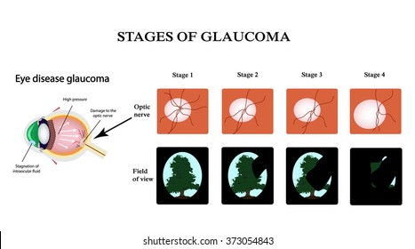 Glaucoma. The structure of the eye. The field of vision in glaucoma. Atrophy of the optic nerve. Infographics. Vector illustration on isolated background