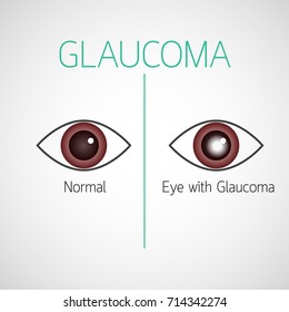 Glaucoma Vector Icon Illustration