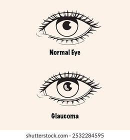 Glaucoma Vetor com Olho Normal