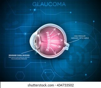 Glaucoma, vision disorder. Detailed anatomy on a blue technology background.