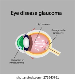 Glaucomatous eye. Violations causing glaucoma. The structure of the eye.