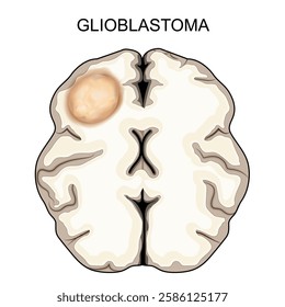 Glioblastoma. Brain tumor. Malignant cancer. Vector illustration