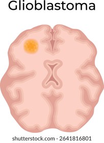Glioblastoma Brain Tumor Vector Illustration