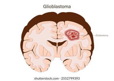 Glioblastoma. Gliomas. Brain tumors vector. Brain cancer. Human brain structure.