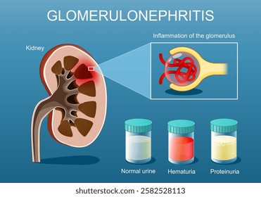 Glomerulonephritis. Cross section of a human kidney. Close-up of glomerulus Inflammation. Test tube with Normal urine, Proteinuria and Hematuria. Blood in urine. Vector poster. Isometric flat