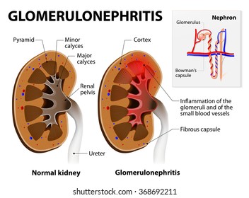 Glomerulonephritis Glomerular Nephritis Kidney Disease Stock Vector ...