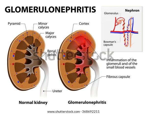 glomerulonephritis