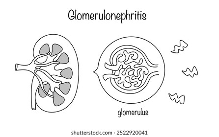 Glomerulonephritis. A kidney disease that affects the glomeruli that filter the blood. Hand drawn line illustration on white background. Vector illustration.