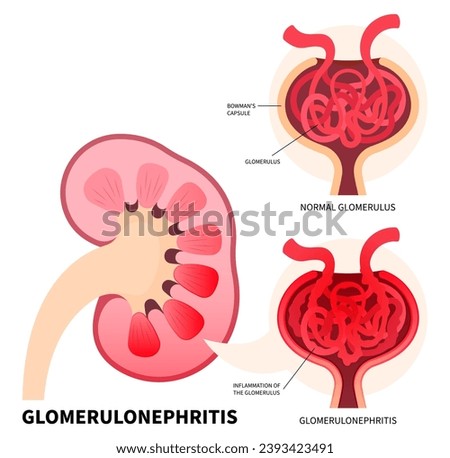 The Glomerulus of kidney disease that show Polycystic cysts and stones with creatinine Peritoneal dialysis or hemodialysis for renal transplant