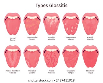 Glossitis. Scarlet tongue disease types, human mouth sore teeth problem healthy or sick xerostomia thrush atrophic candidiasis bacteria infections ulcera swanky vector illustration