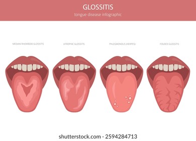 Glossitis tongue disease. Oral medicine. Medical infographic design. Vector illustration