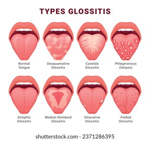 Glossitis type candidiasis of tongue thrush inflammation educational poster with names vector flat illustration. Human open mouth anatomy normal and disease oral sore problem unhealthy fungal virus