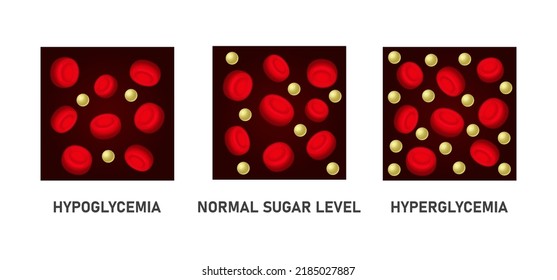 Glucose Blood Sugar Level Set. Hypoglycemia and Hyperglycemia Icons. Vector