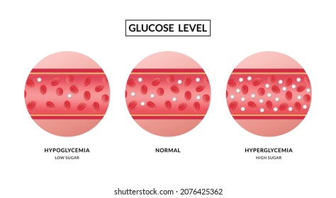 Glucose in the blood vessel. Hypoglycemia and Hyperglycemia