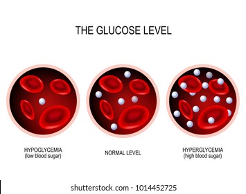 Glucose in the blood vessel. normal level, hyperglycemia (high blood sugar), hypoglycemia (low blood sugar). vector diagram