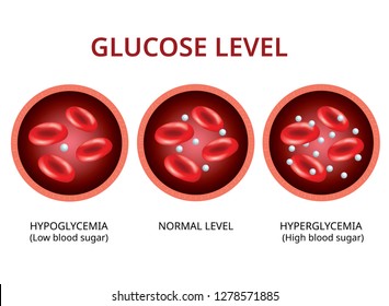 Glucose level in the blood vessel, normal level, hyperglycemia (high blood sugar), hypoglycemia (low blood sugar) Vector Illustration