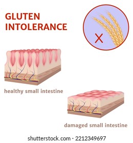 Intolerancia gluten. Superficie dañada del intestino delgado. Afiche médico. Ilustración del vector