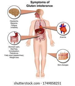 gluten intolerance infographic, 3d medical vector illustration isolated on white background