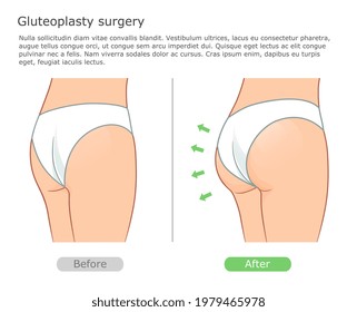 Ilustración quirúrgica de luteoplastia antes y después. Procedimiento de corrección de las nalgas con implantación.