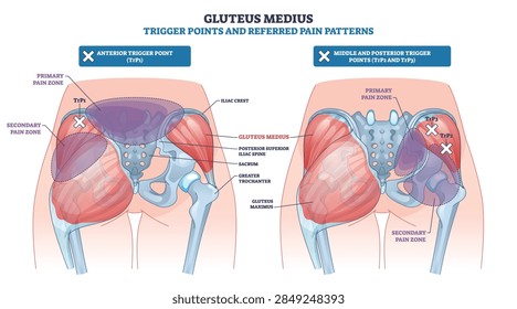 Gluteus medius trigger points map referred pain patterns across hip and pelvis, showing muscle fibers, X-marked TrPs, and shaded pain zones for clinical guidance. Outline diagram