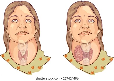 Goiter 