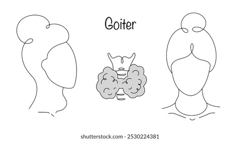 Bócio. Doença caracterizada por aumento da glândula tireoide. Uma mulher com uma manifestação de glândula tireoide aumentada no pescoço. Ilustração simples para uso na área médica.